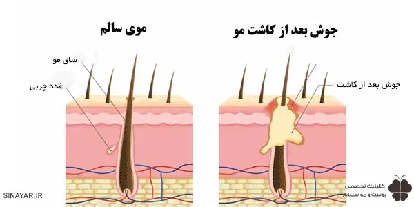  کیست مویی بعد از کاشت مو