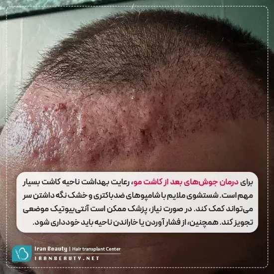  کیست مویی بعد از کاشت مو