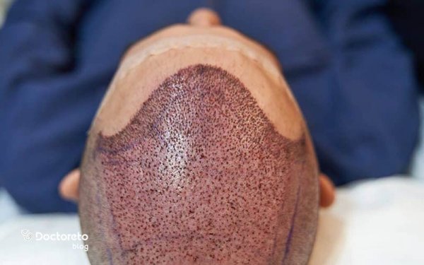  کیست مویی بعد از کاشت مو