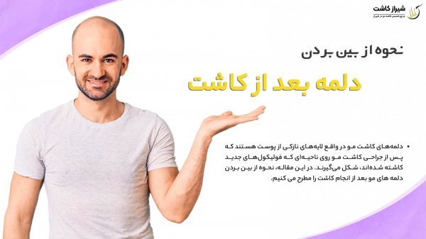  کیست مویی بعد از کاشت مو