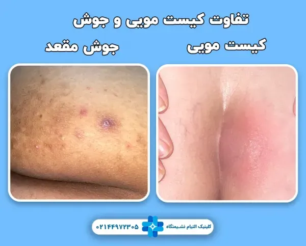  برای کیست مویی چه دکتری باید رفت؟