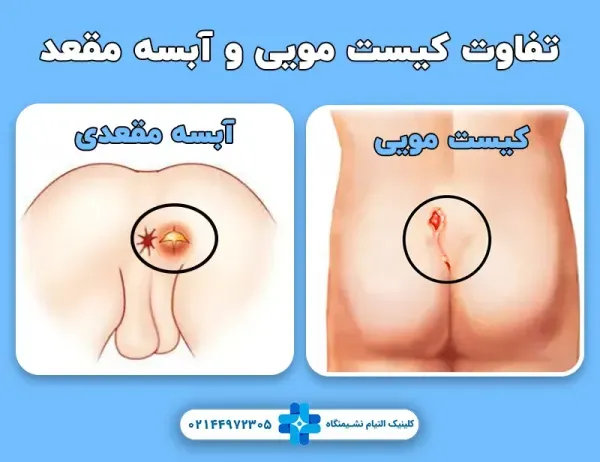  برای کیست مویی چه دکتری باید رفت؟