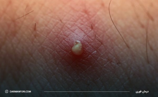  برای کیست مویی چه دکتری باید رفت؟