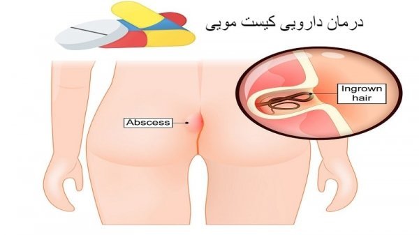  برای کیست مویی چه دکتری باید رفت؟