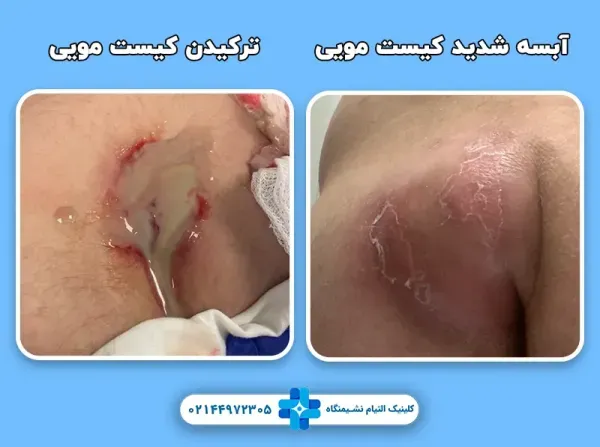  اگر کیست مویی بترکد چه میشود؟