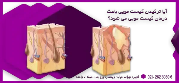  اگر کیست مویی بترکد چه میشود؟