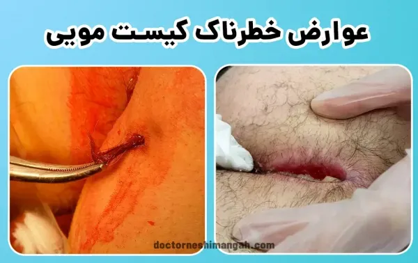  اگر کیست مویی بترکد چه میشود؟