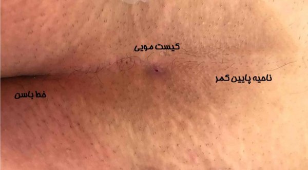  اگر کیست مویی بترکد چه میشود؟