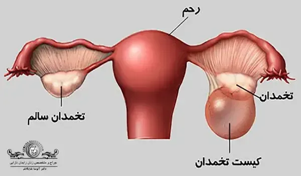 آیا کیست مویی تخمدان خطرناک است +عکس فیلم کیست درموئید