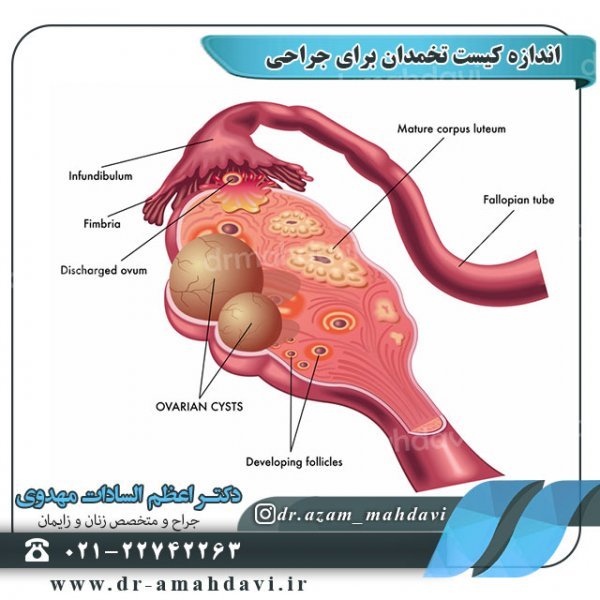  آیا کیست مویی تخمدان خطرناک است +عکس فیلم کیست درموئید