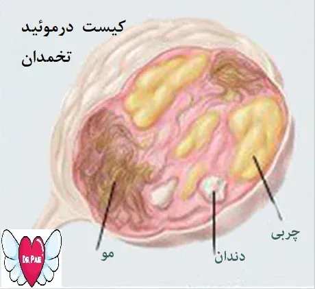  آیا کیست مویی تخمدان خطرناک است +عکس فیلم کیست درموئید