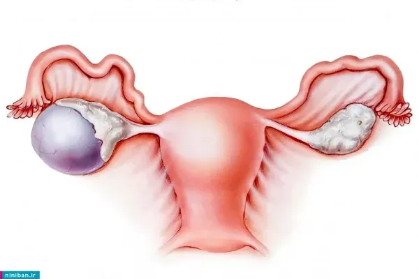  آیا کیست مویی تخمدان خطرناک است +عکس فیلم کیست درموئید