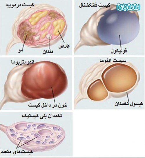  آیا کیست مویی تخمدان خطرناک است +عکس فیلم کیست درموئید