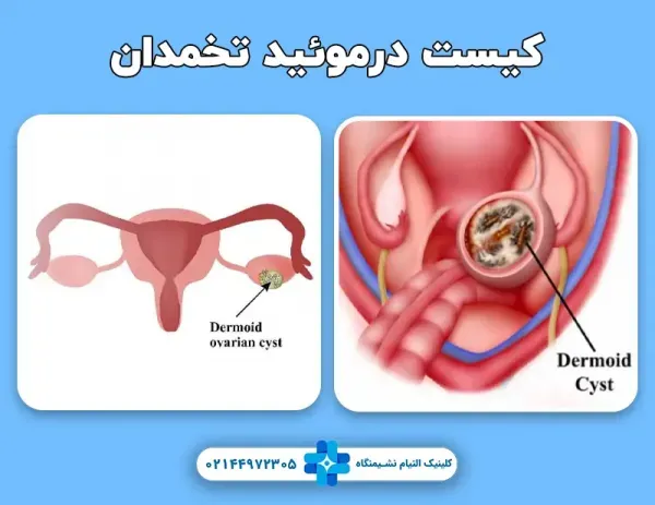  آیا کیست مویی تخمدان خطرناک است +عکس فیلم کیست درموئید
