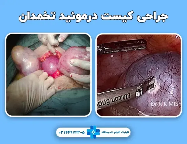  آیا کیست مویی تخمدان خطرناک است +عکس فیلم کیست درموئید