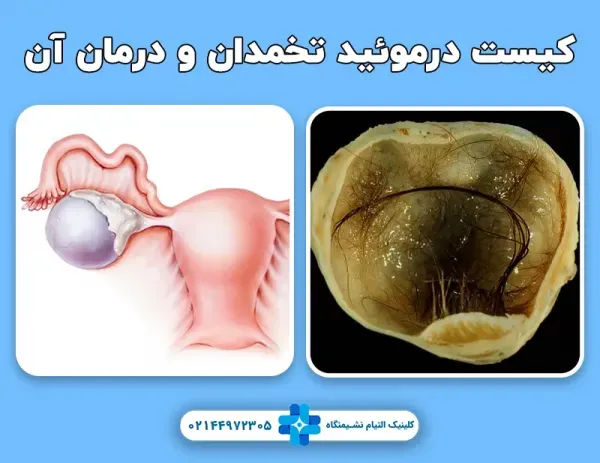  آیا کیست مویی تخمدان خطرناک است +عکس فیلم کیست درموئید