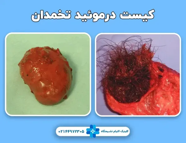  آیا کیست مویی تخمدان خطرناک است +عکس فیلم کیست درموئید