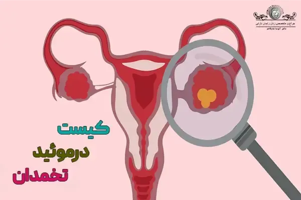  آیا کیست مویی تخمدان خطرناک است +عکس فیلم کیست درموئید
