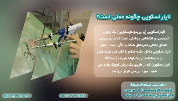  فیلم عمل کیست تخمدان با لیزر