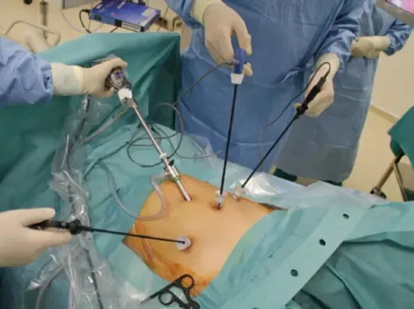  فیلم عمل کیست تخمدان با لیزر