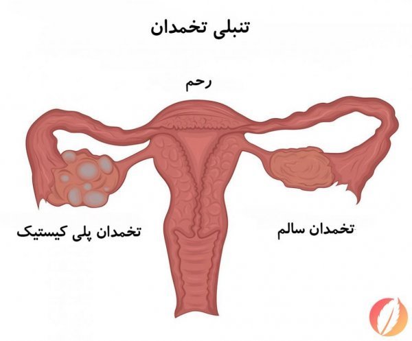 آیا با وجود کیست و تنبلی تخمدان میتوان باردار شد؟