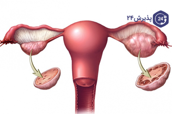  آیا با وجود کیست و تنبلی تخمدان میتوان باردار شد؟