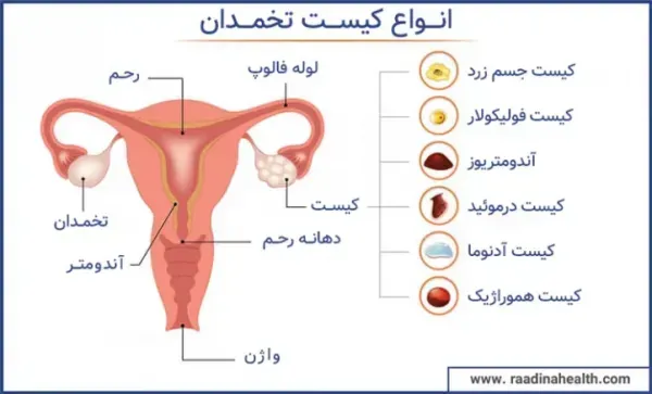  آیا با وجود کیست و تنبلی تخمدان میتوان باردار شد؟