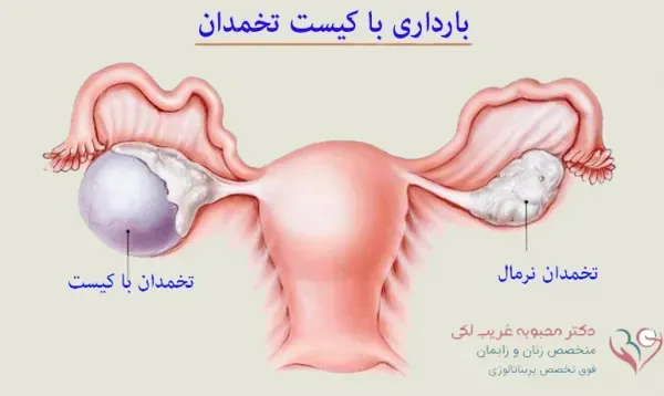  آیا با وجود کیست و تنبلی تخمدان میتوان باردار شد؟