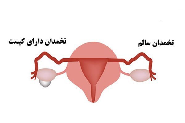  آیا با وجود کیست و تنبلی تخمدان میتوان باردار شد؟