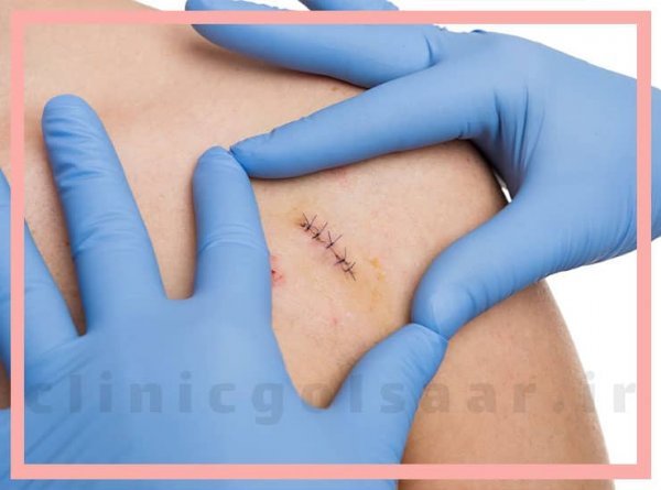  پماد موپیروسین ۲ درصد برای چیست