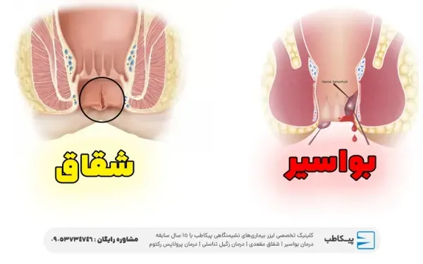 عکس شقاق و بواسیر