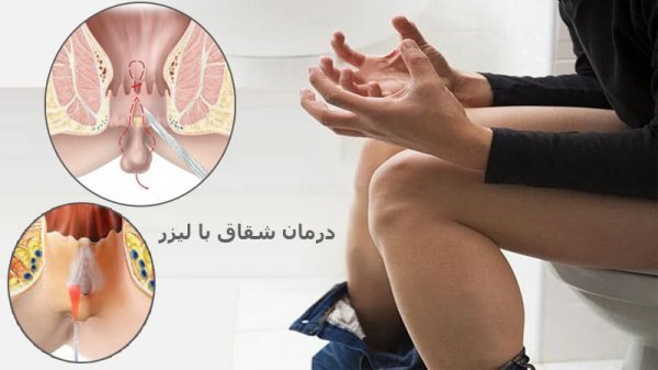 درمان شقاق / فیشر با لیزر بهتر است یا جراحی