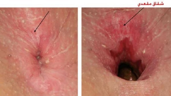  درمان شقاق / فیشر با لیزر بهتر است یا جراحی