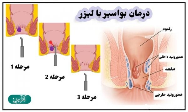  درمان شقاق / فیشر با لیزر بهتر است یا جراحی