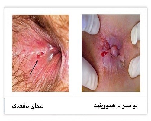 هموروئید با بواسیر چه فرقی دارد؟