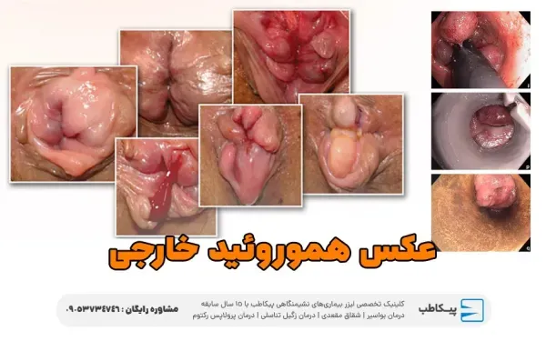  هموروئید با بواسیر چه فرقی دارد؟