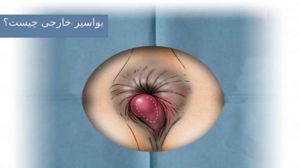  هموروئید با بواسیر چه فرقی دارد؟