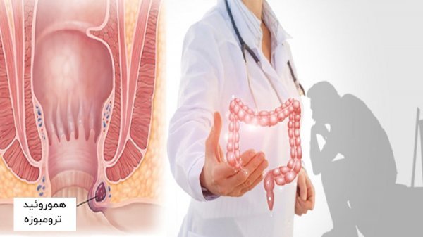  هموروئید با بواسیر چه فرقی دارد؟