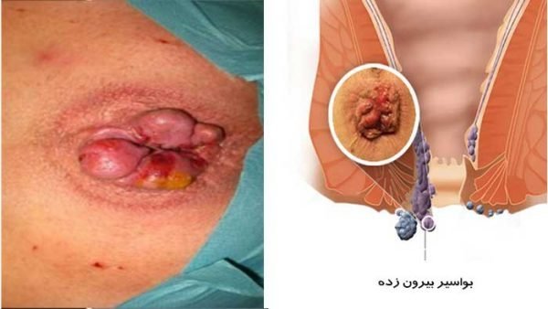  هموروئید با بواسیر چه فرقی دارد؟