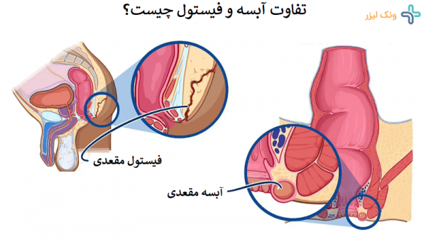  هموروئید با بواسیر چه فرقی دارد؟