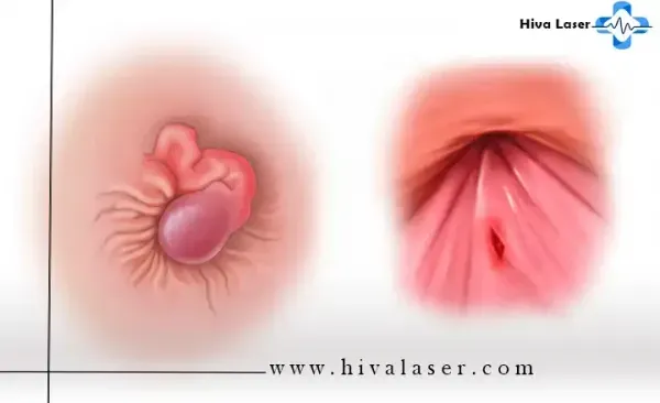  هموروئید با بواسیر چه فرقی دارد؟