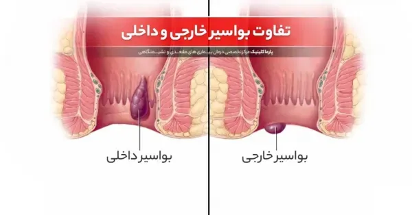  هموروئید با بواسیر چه فرقی دارد؟