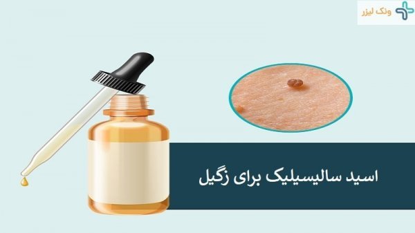  قیمت اسید سالیسیلیک برای زگیل تناسلی/قطره زگیل
