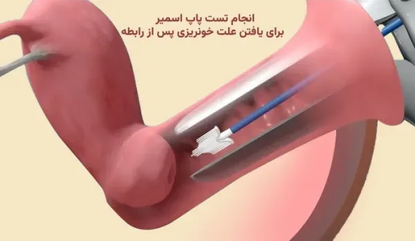  ترشحات قهوه ای بعد از پاپ اسمیر