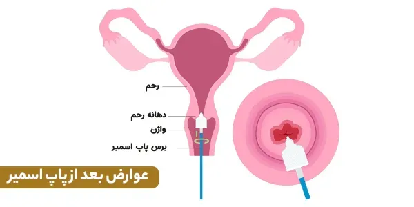  آزمایش پاپ اسمیر چه زمانی باید انجام شود؟
