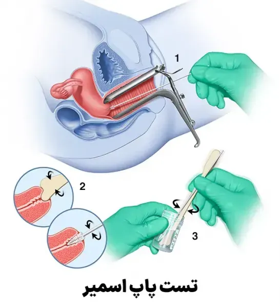  قیمت آزمایش / تست پاپ اسمیر چقدر است/سال 1404