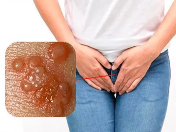 زگیل تناسلی چه شکلیه در زنان؟