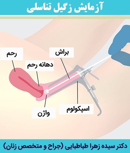 زگیل تناسلی چه شکلیه در زنان؟