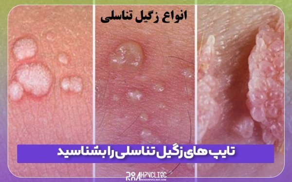  زگیل تناسلی چه شکلیه در زنان؟