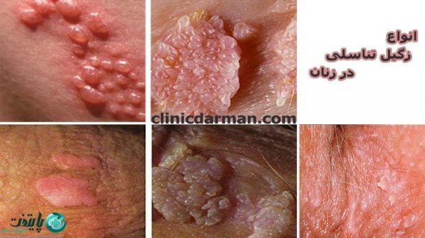  زگیل تناسلی چه شکلیه در زنان؟